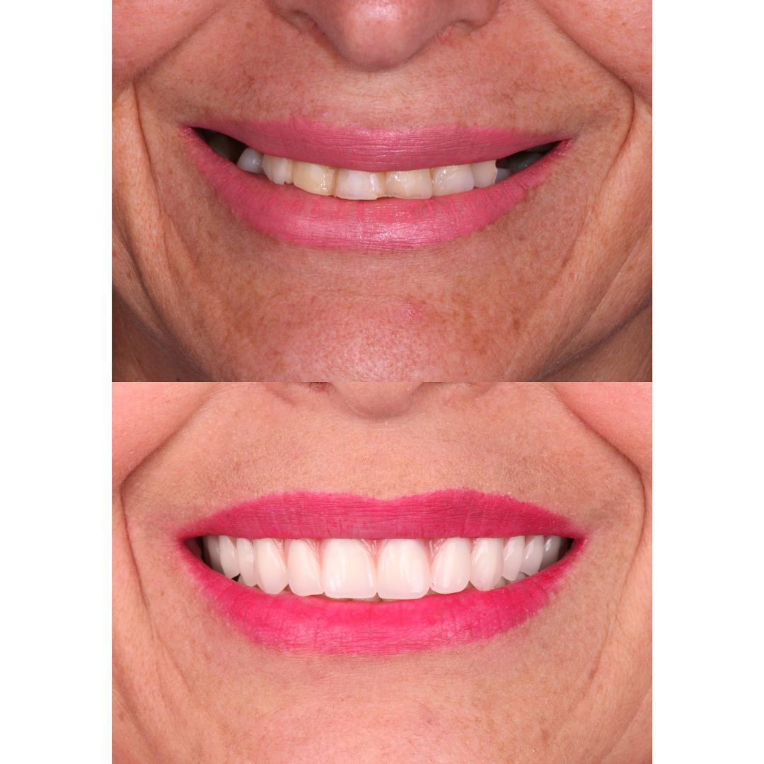 Dentadura fixa protocolo antes e depois