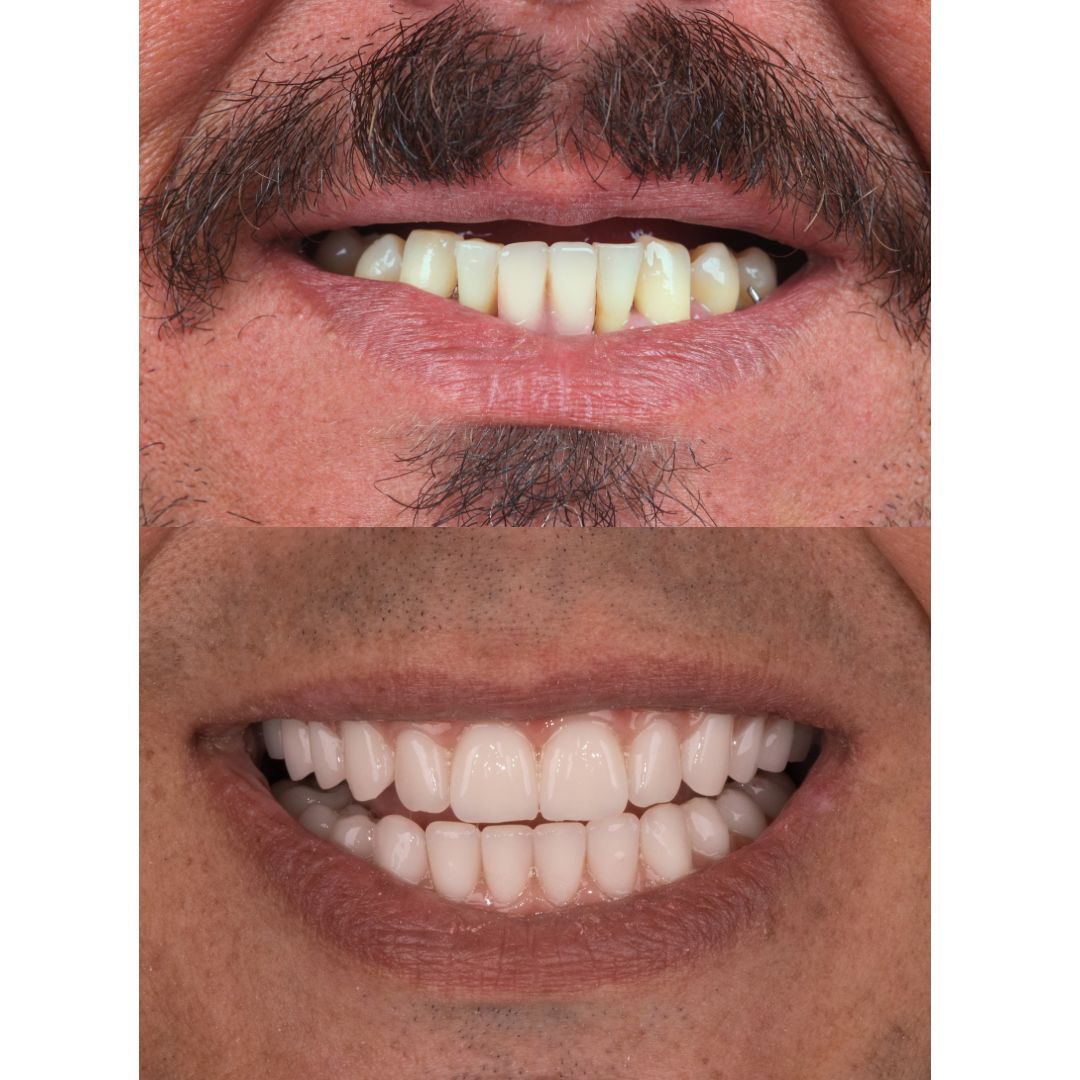 Antes e depois de Prótese Protocolo em Botucatu
