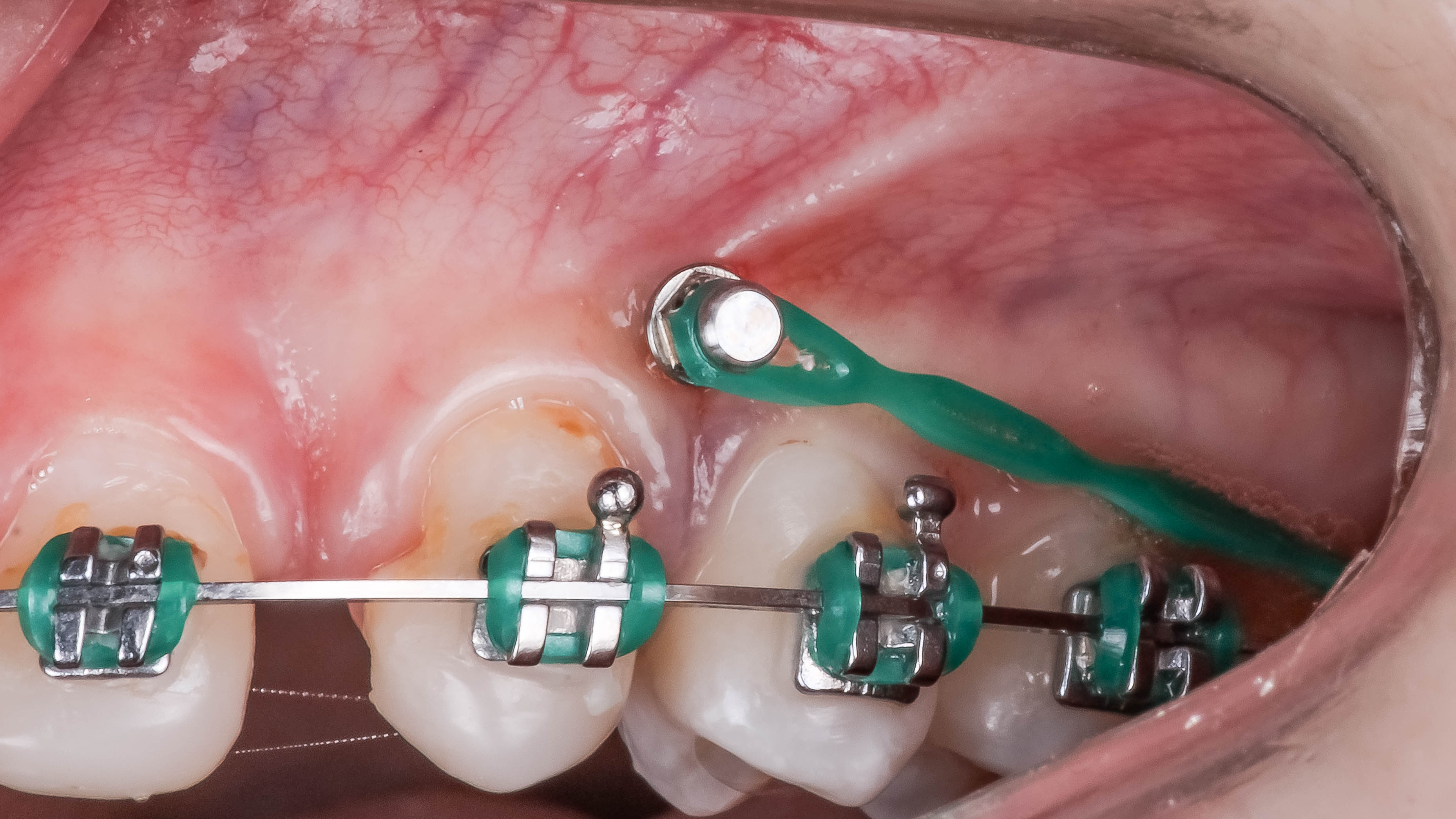 Imagem clínica de alta tecnologia para mini implantes