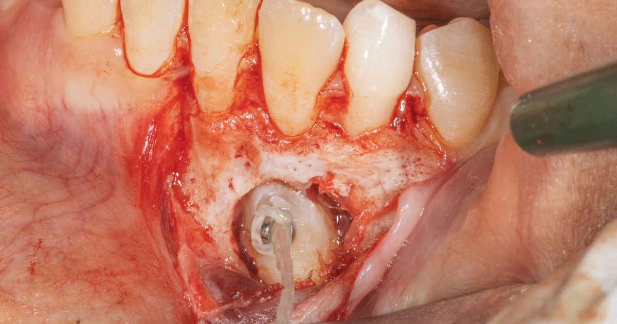 Imagem radiográfica clínica focada em odontologia e dentes